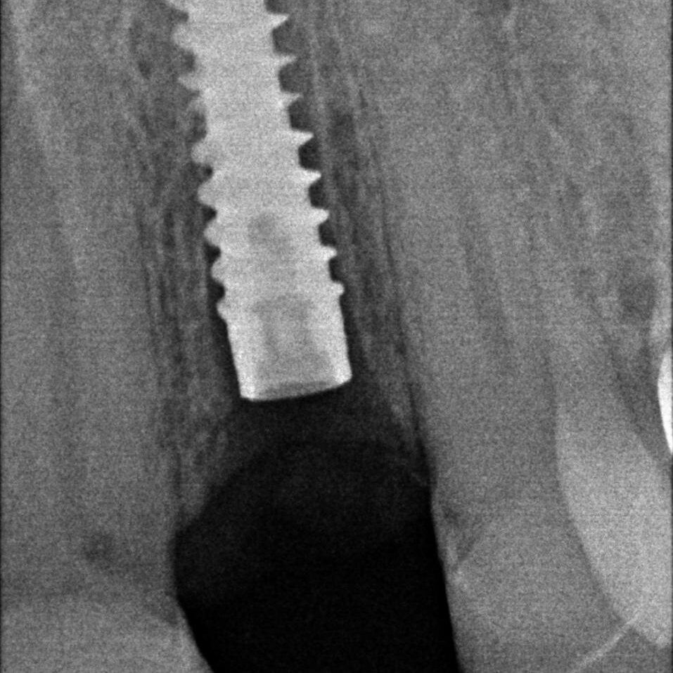 dr-carl-de-villiers-services-page-implants