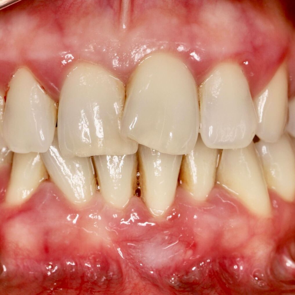 dr-carl-de-villiers-services-page-periodontitis